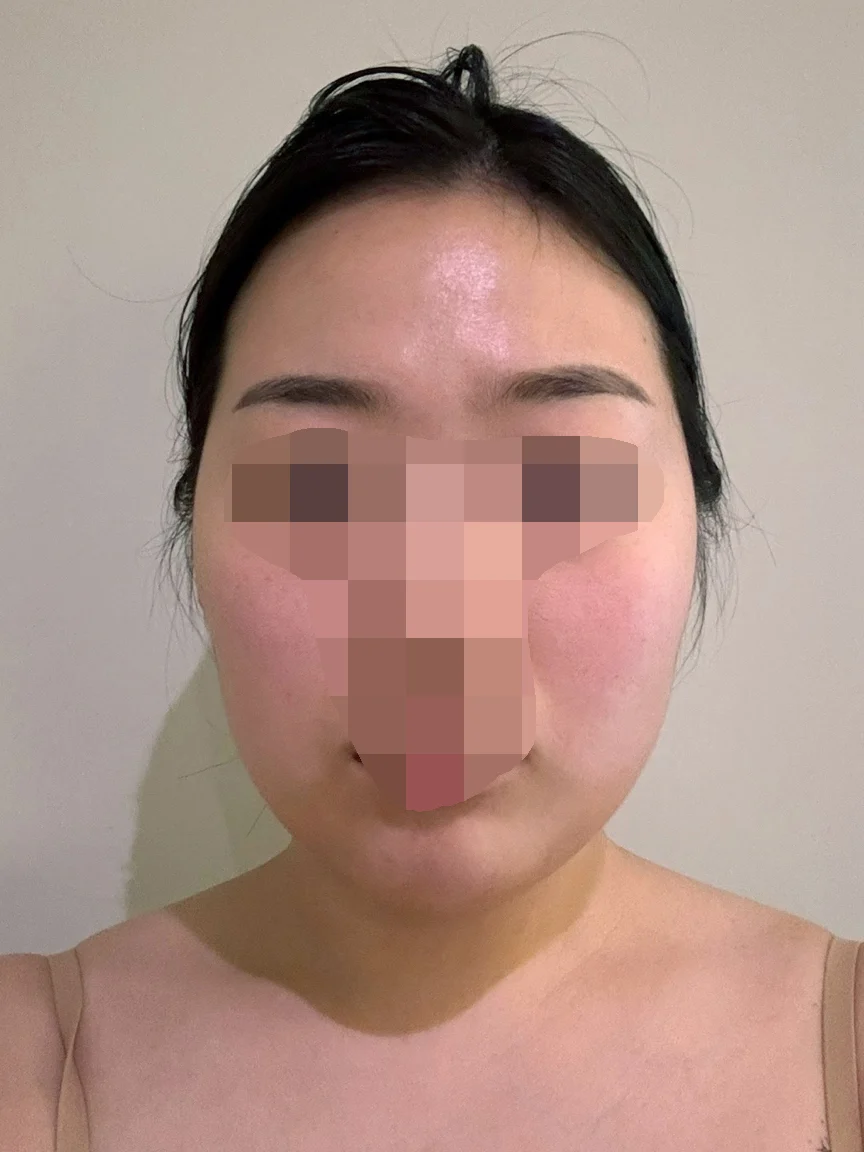 I had facial and double chin liposuction - Facial Liposuction Before 2 - TheLINE Plastic Surgery