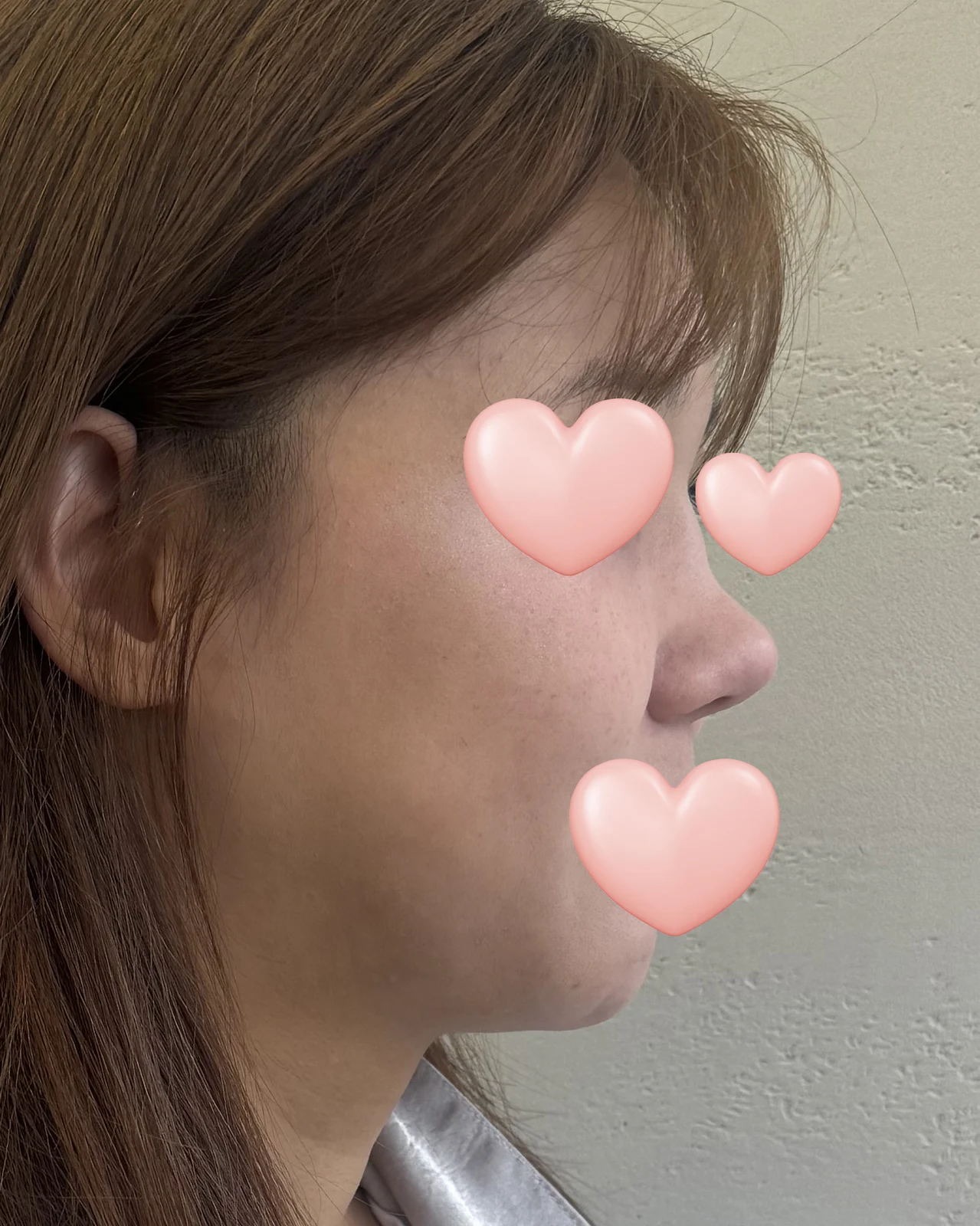 Nose revision surgery review - Facial Plastic Surgery Before 2 - TheLINE Plastic Surgery