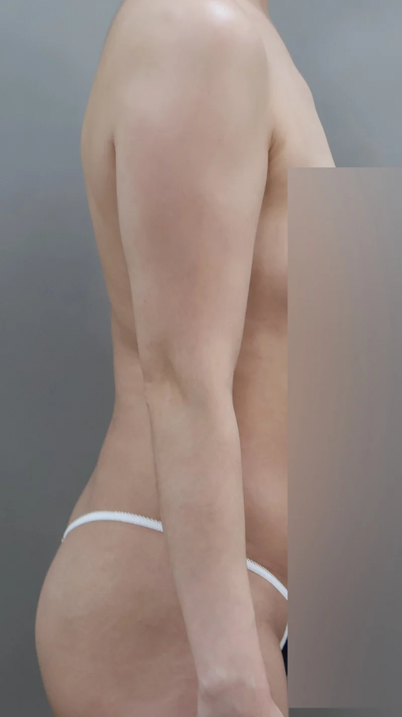 Arm and accessory breast liposuction, so - Arm Liposuction Before 2 - TheLINE Plastic Surgery