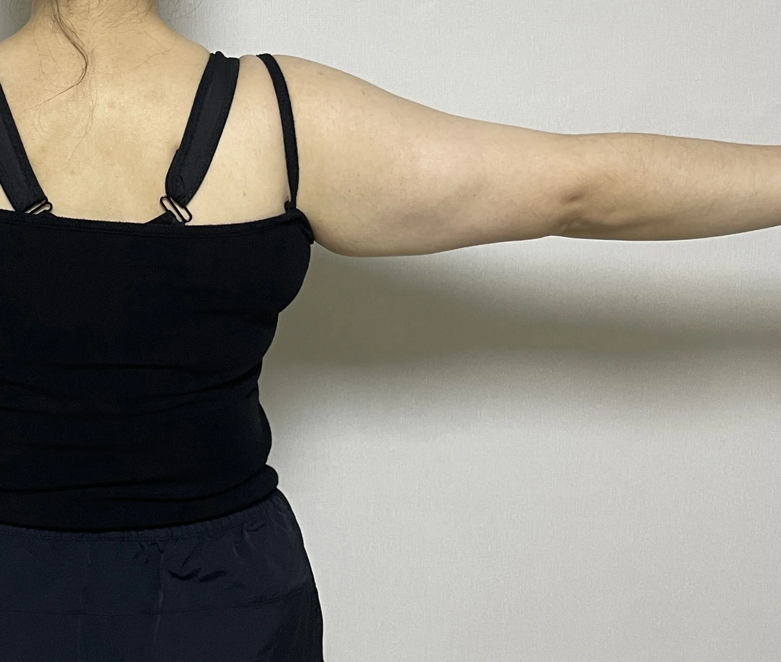 6 months after my arm lift! The best thi - Body Contouring Before 2 - TheLINE Plastic Surgery