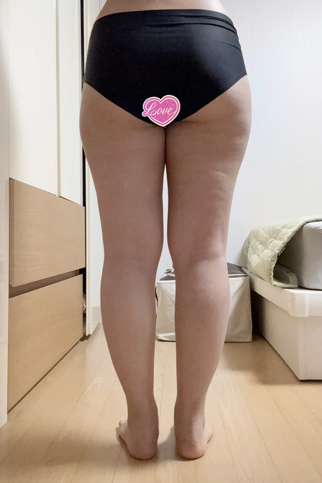 It's been 6 months since my thigh and kn - Thigh Liposuction (Lower Body) Before 2 - TheLINE Plastic Surgery