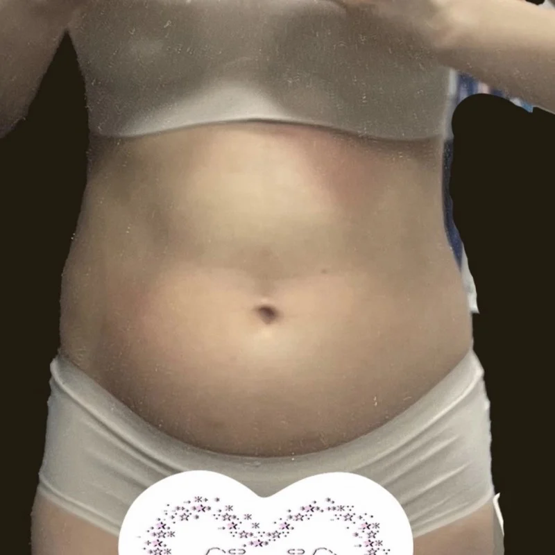 I'm finally free - Abdominal Liposuction (Upper Body) Before 2 - TheLINE Plastic Surgery