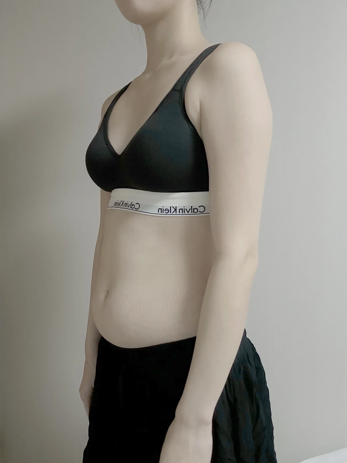 4 months after arm, accessory breast and - Arm Liposuction Before 2 - TheLINE Plastic Surgery
