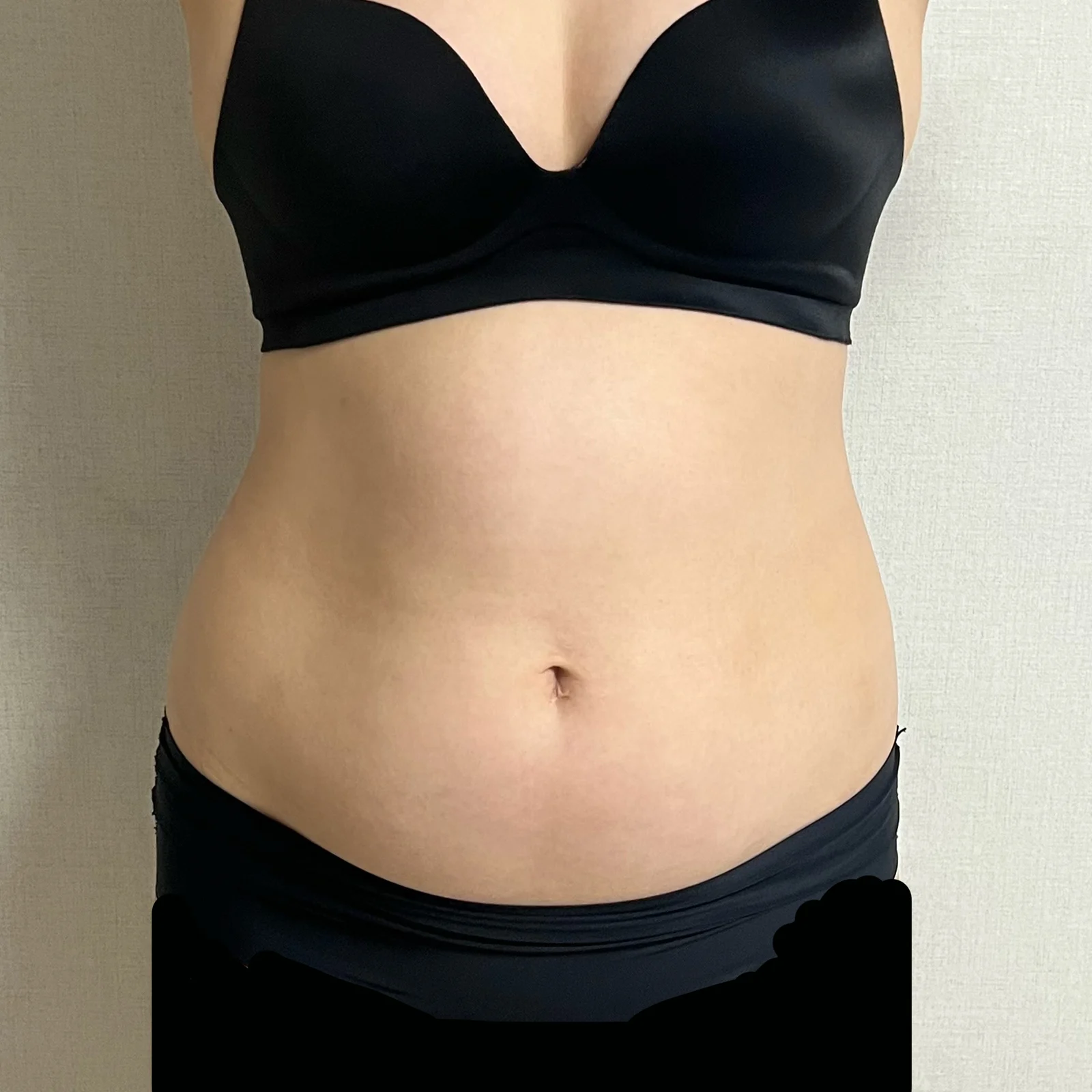 My 3-month review of abdomen and love ha - Abdominal Liposuction (Upper Body) surgery Before photo - TheLINE Plastic Surgery