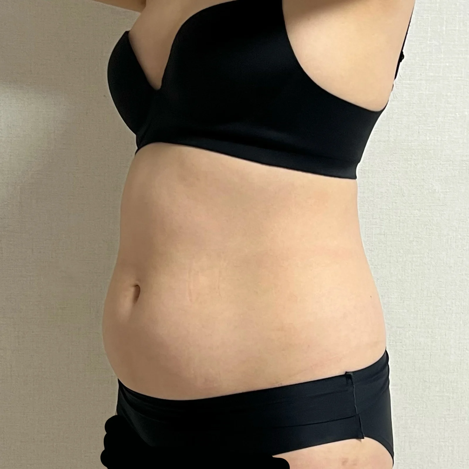 My 3-month review of abdomen and love ha - Abdominal Liposuction (Upper Body) Before 2 - TheLINE Plastic Surgery