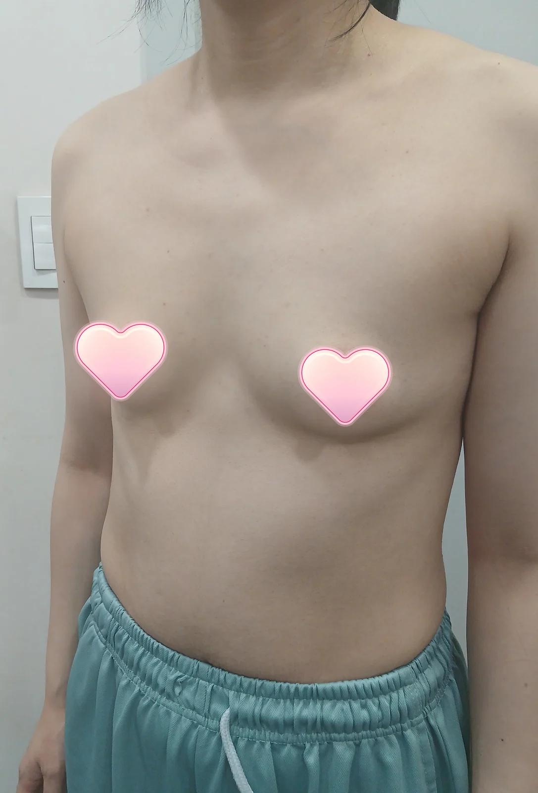 Breast surgery review - Body Contouring Before 2 - TheLINE Plastic Surgery