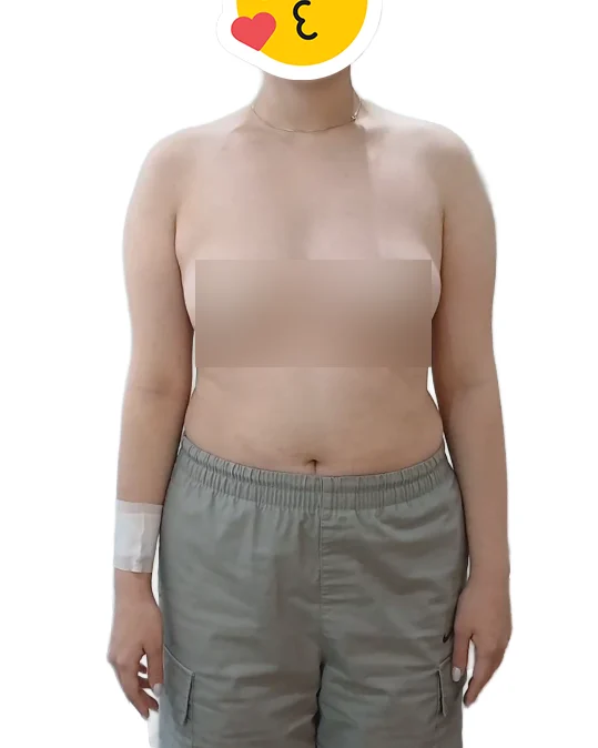 It's been a month since my upper arm lip - Arm Liposuction Before 2 - TheLINE Plastic Surgery