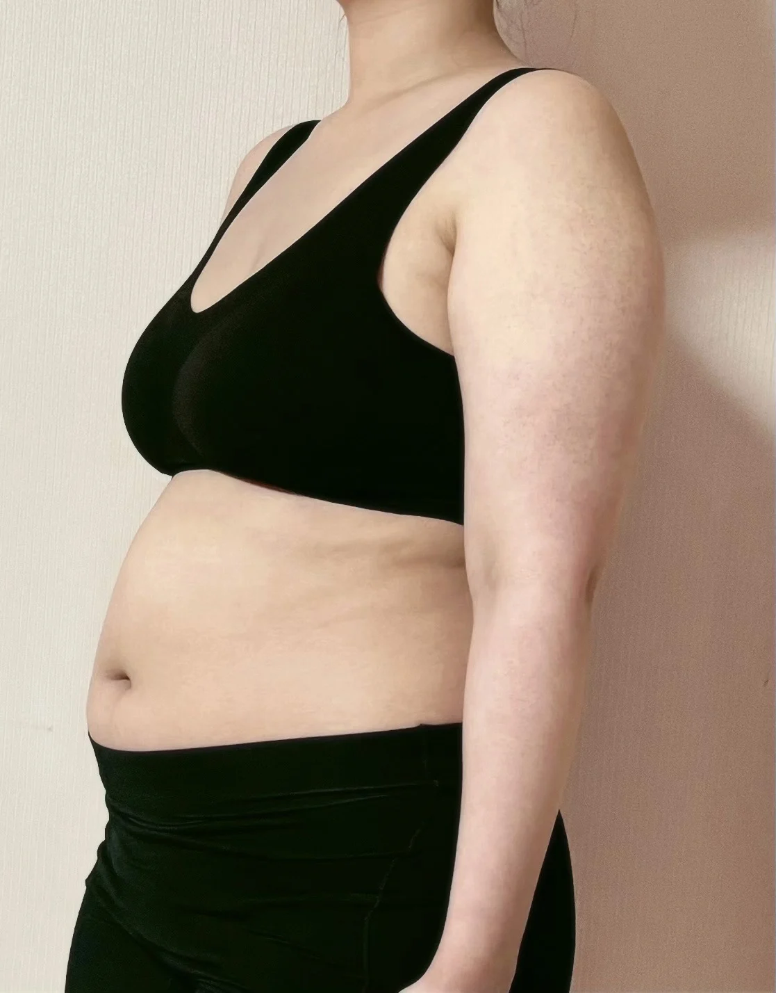 Totally Satisfied!! - Arm Liposuction Before 2 - TheLINE Plastic Surgery