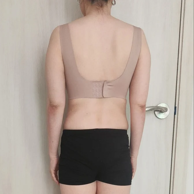 Arm Lift Review - Body Contouring Before 2 - TheLINE Plastic Surgery