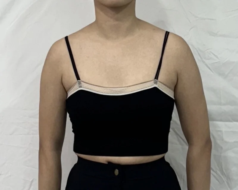 Go for It Right Away!! - Arm Liposuction Before 2 - TheLINE Plastic Surgery