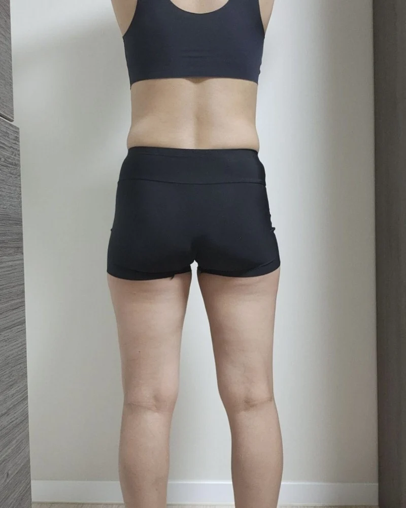 It Has Been 1 Month Since Surgery - Abdominal Liposuction (Upper Body) Before 2 - TheLINE Plastic Surgery