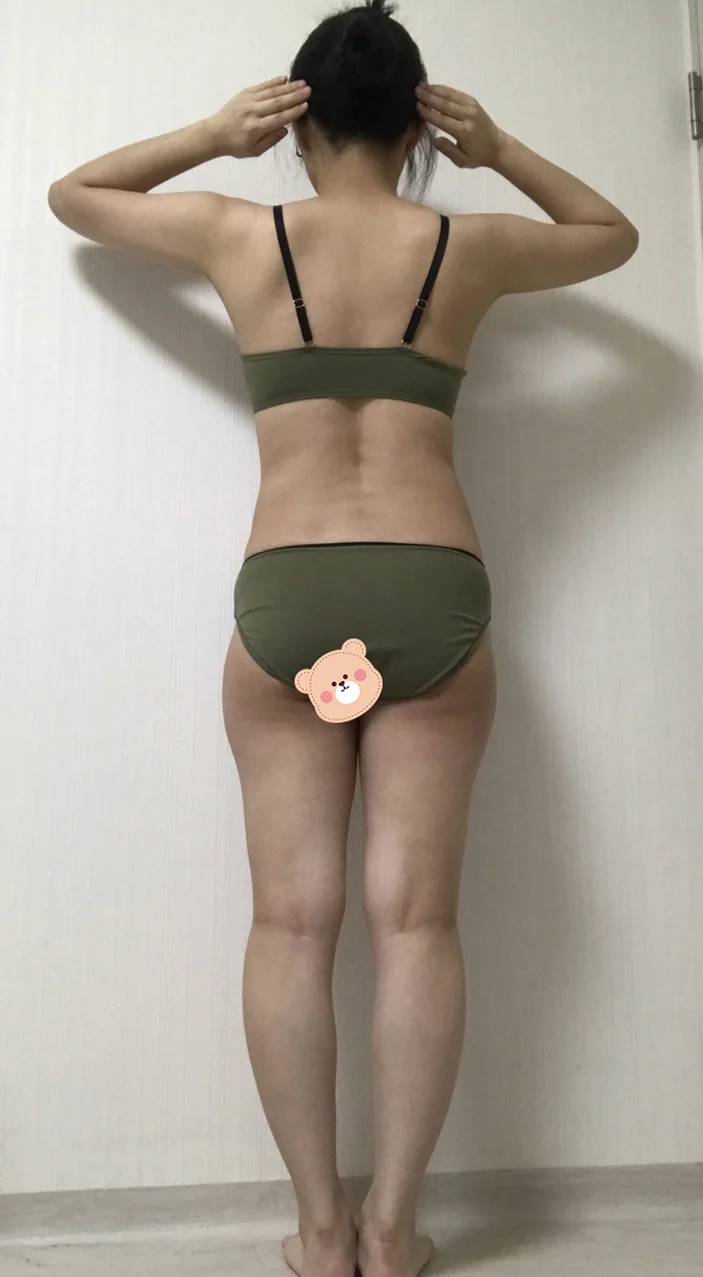 Abdomen, Love Handles, Thigh Lipo + Hip  - Body Contouring Before 2 - TheLINE Plastic Surgery