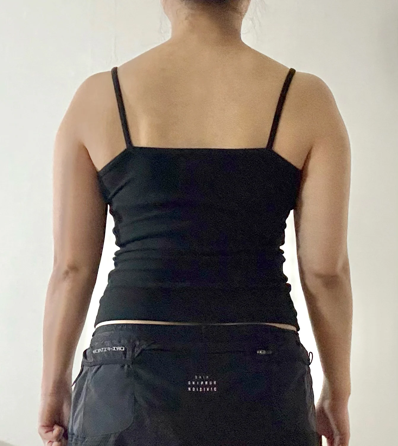 It Has Been a Month Since My Arm Liposuc - Arm Liposuction Before 2 - TheLINE Plastic Surgery
