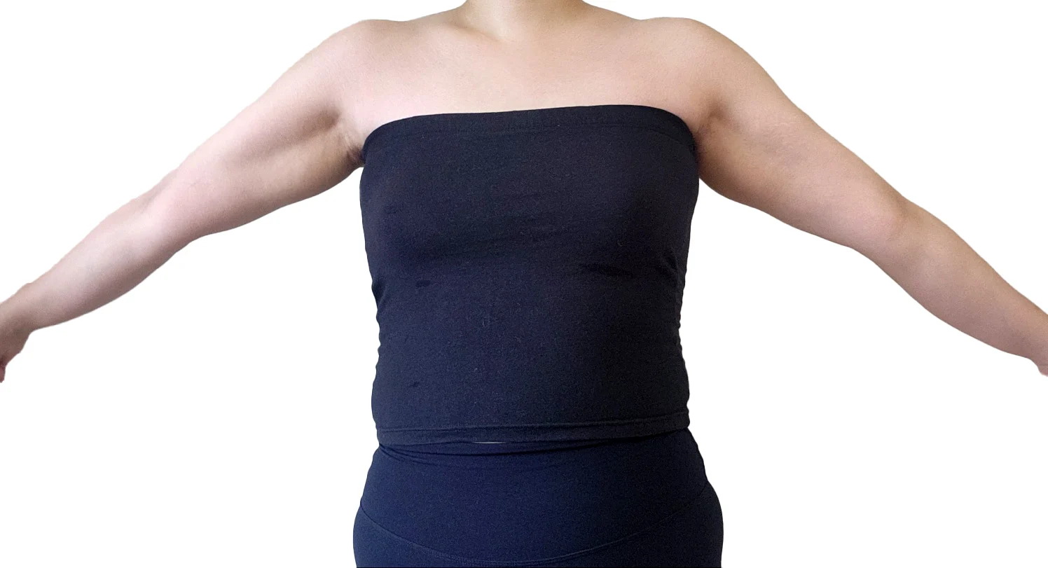 Arm Lift, 6 Months - Body Contouring Before 2 - TheLINE Plastic Surgery