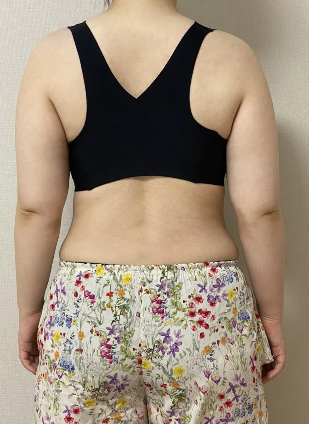 Dr. Jaeho Cho Is the Best♥ - Arm Liposuction Before 2 - TheLINE Plastic Surgery