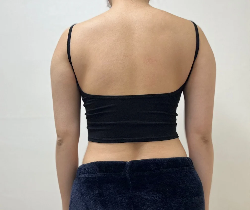 One Month After Arm and Accessory Breast - Arm Liposuction Before 2 - TheLINE Plastic Surgery