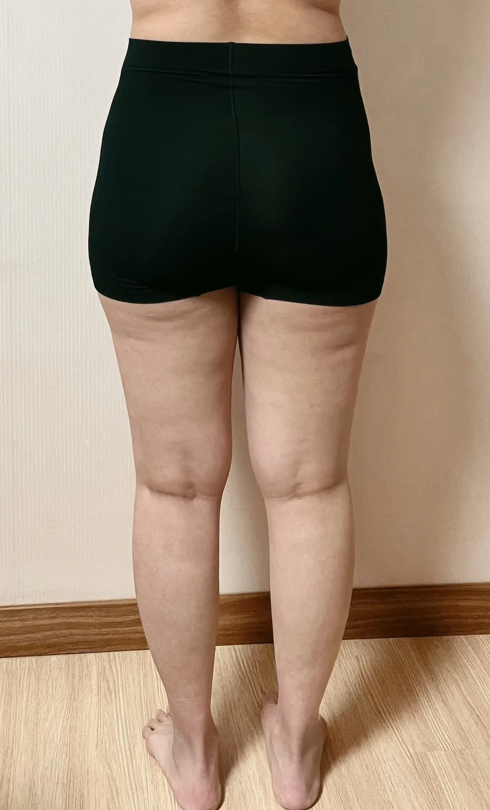 It Has Been a Month Since My Thigh Lipos - Thigh Liposuction (Lower Body) Before 2 - TheLINE Plastic Surgery
