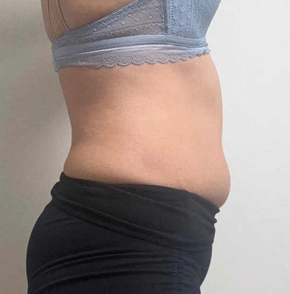Abdominal Lipo Review!!!! - Abdominal Liposuction (Upper Body) Before 2 - TheLINE Plastic Surgery
