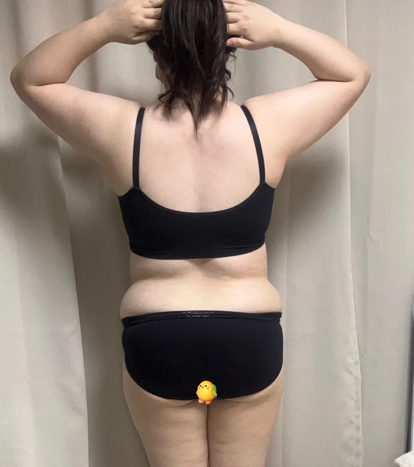 One Month After Upper Body Lipo - Abdominal Liposuction (Upper Body) Before 2 - TheLINE Plastic Surgery