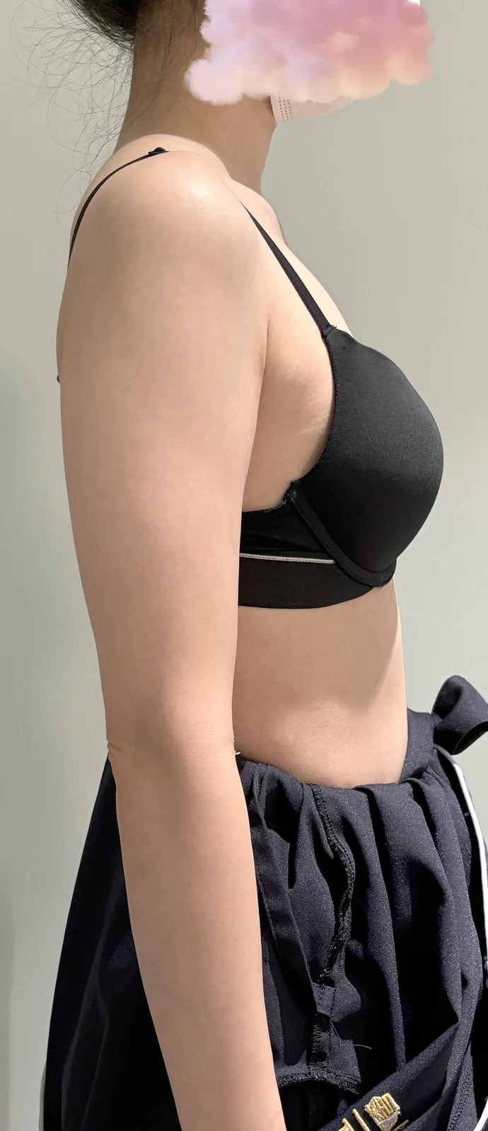 Top Satisfaction!!!! - Arm Liposuction Before 2 - TheLINE Plastic Surgery