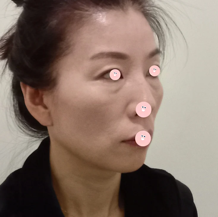 Facial Fat Grafting Review - Facial Fat Grafting Before 2 - TheLINE Plastic Surgery