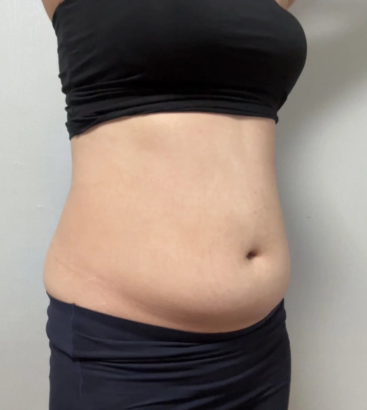 Abdominal Liposuction Review (One Month) - Abdominal Liposuction (Upper Body) Before 2 - TheLINE Plastic Surgery