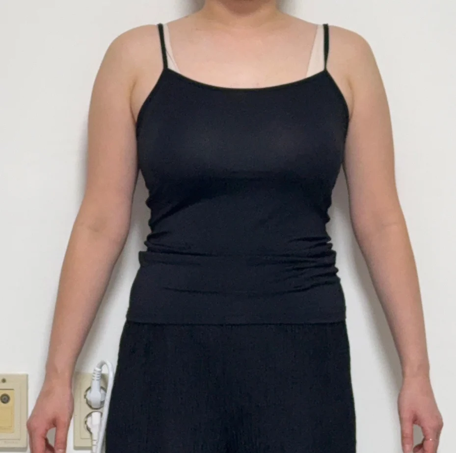 Successful Upper Arm Lipo Review~ - Arm Liposuction Before 2 - TheLINE Plastic Surgery