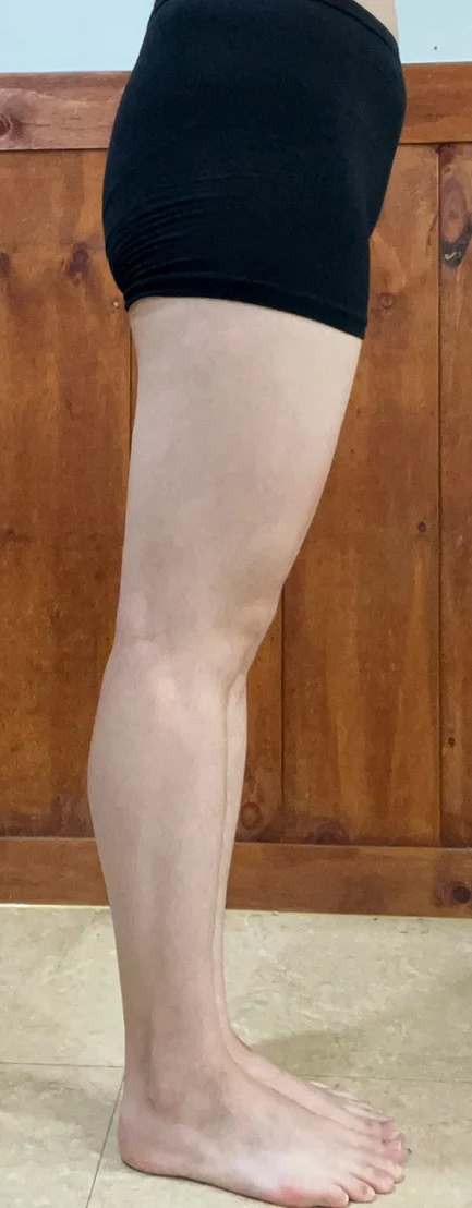 Thigh and Knee Liposuction, 6 Months - Thigh Liposuction (Lower Body) surgery Before photo - TheLINE Plastic Surgery