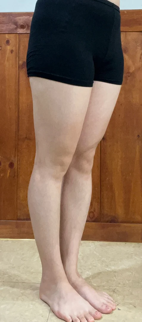 Thigh and Knee Liposuction, 6 Months - Thigh Liposuction (Lower Body) Before 2 - TheLINE Plastic Surgery