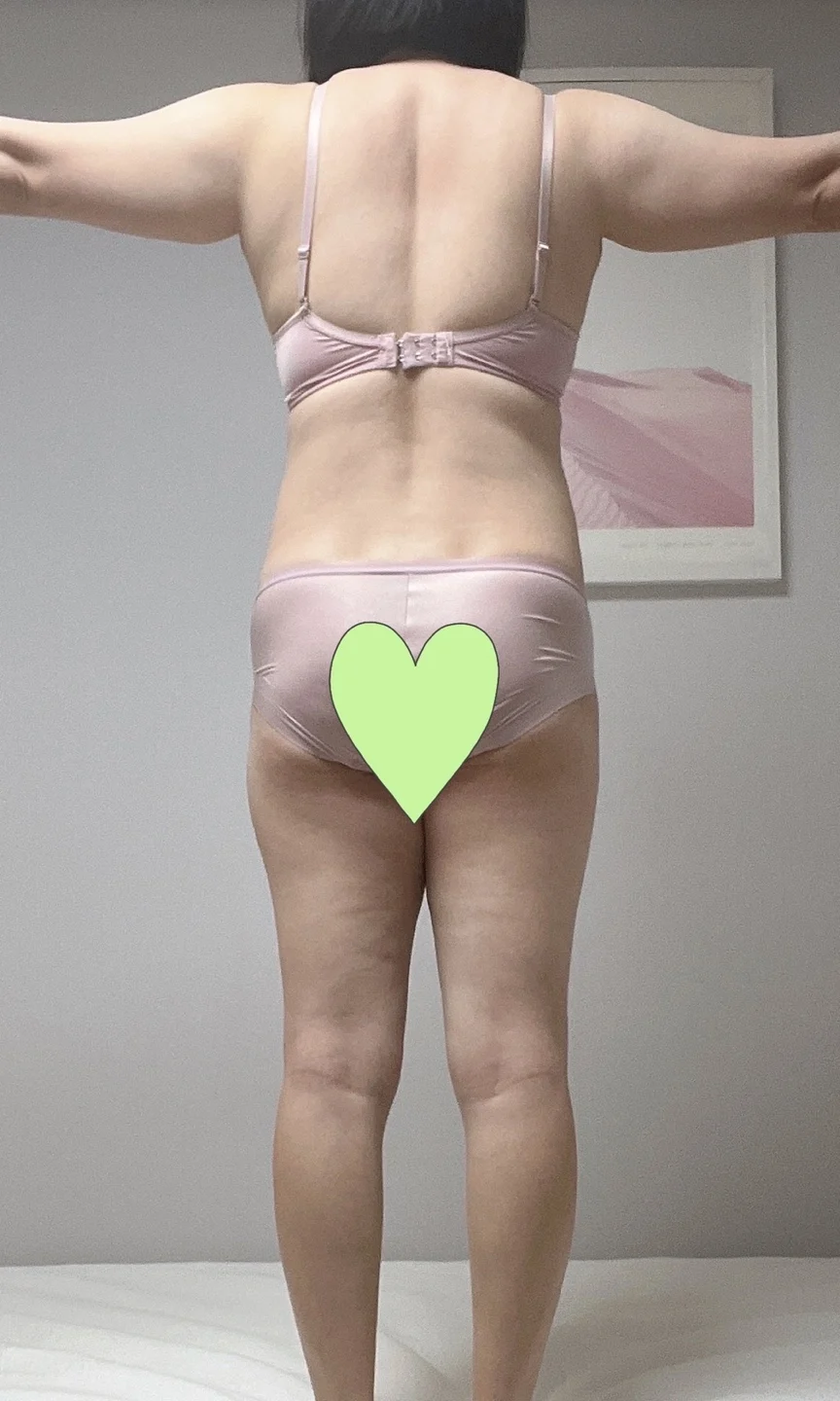 Full-Body Lipo and Hip Dip Grafting Revi - Hip Fat Grafting Before 2 - TheLINE Plastic Surgery