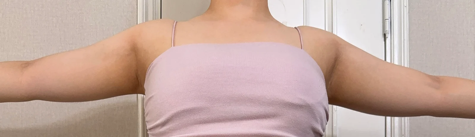 My 3-Month Arm Liposuction Review - Arm Liposuction Before 2 - TheLINE Plastic Surgery