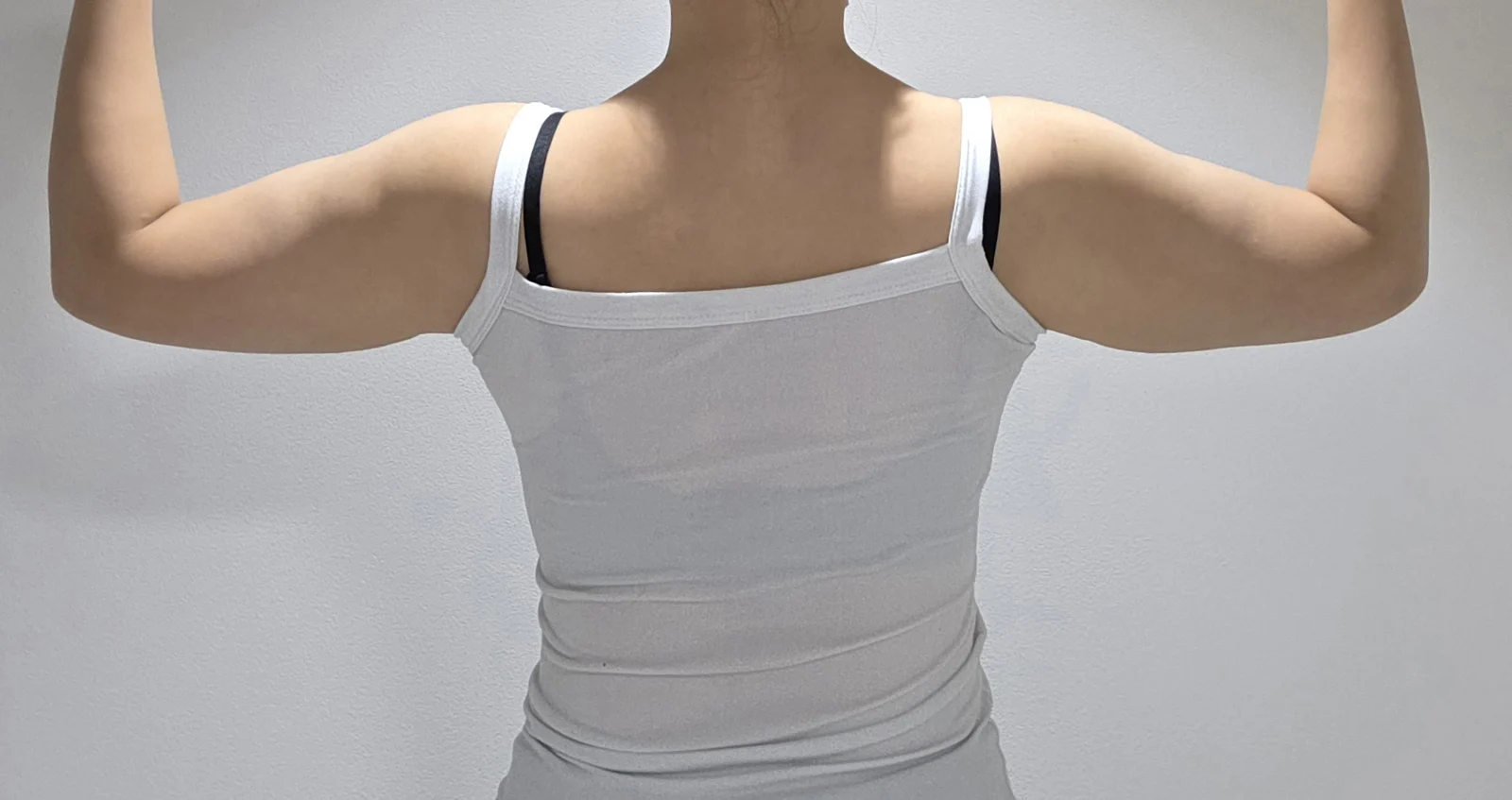 Arm Lipo Revision + Arm Lift Review - Body Contouring Before 2 - TheLINE Plastic Surgery