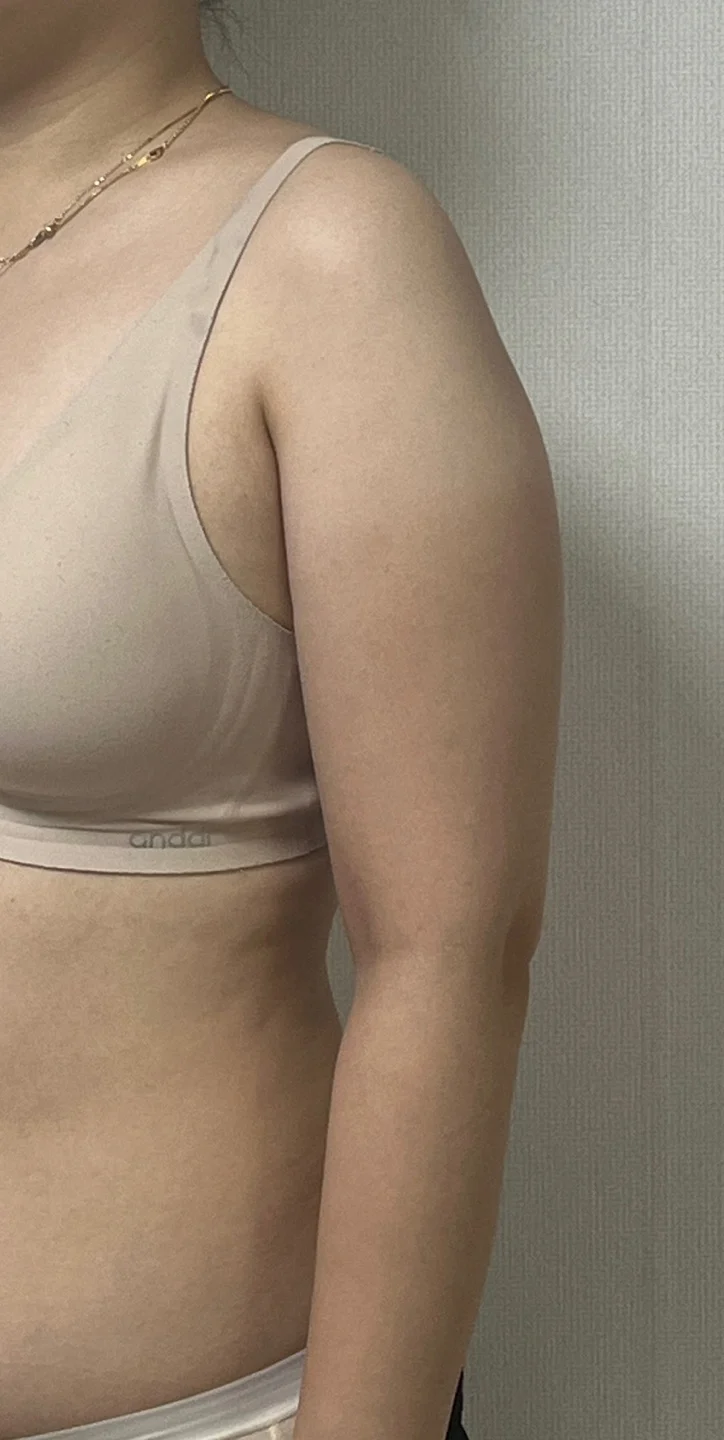 3-month review of 360 arm and accessory  - Arm Liposuction Before 2 - TheLINE Plastic Surgery