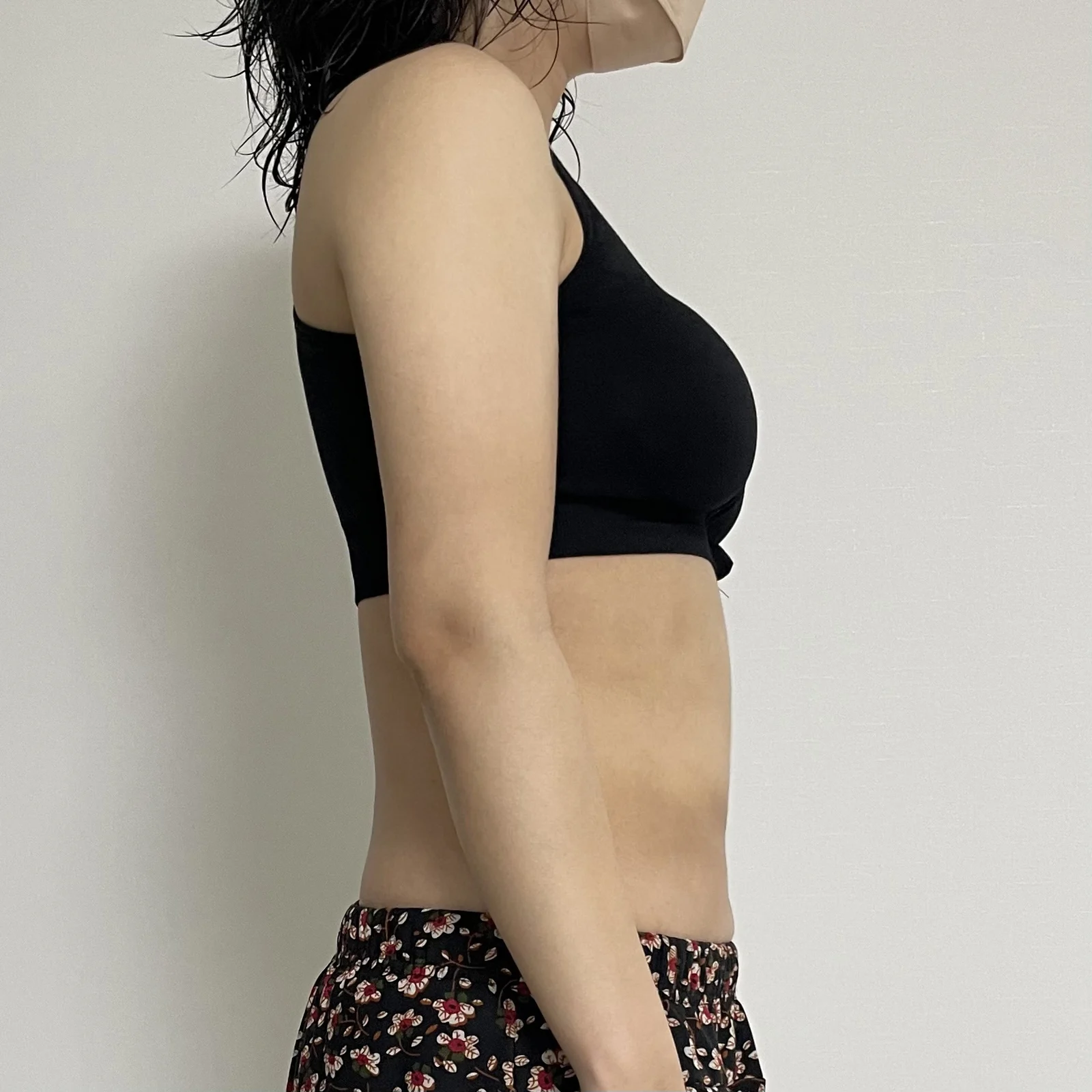Abdomen and arm lipo review~~ - Arm Liposuction After 4 - TheLINE Plastic Surgery