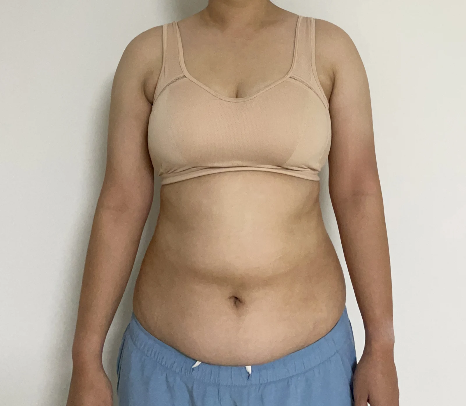 Abdomen and arm lipo review~~ - Arm Liposuction surgery Before photo - TheLINE Plastic Surgery