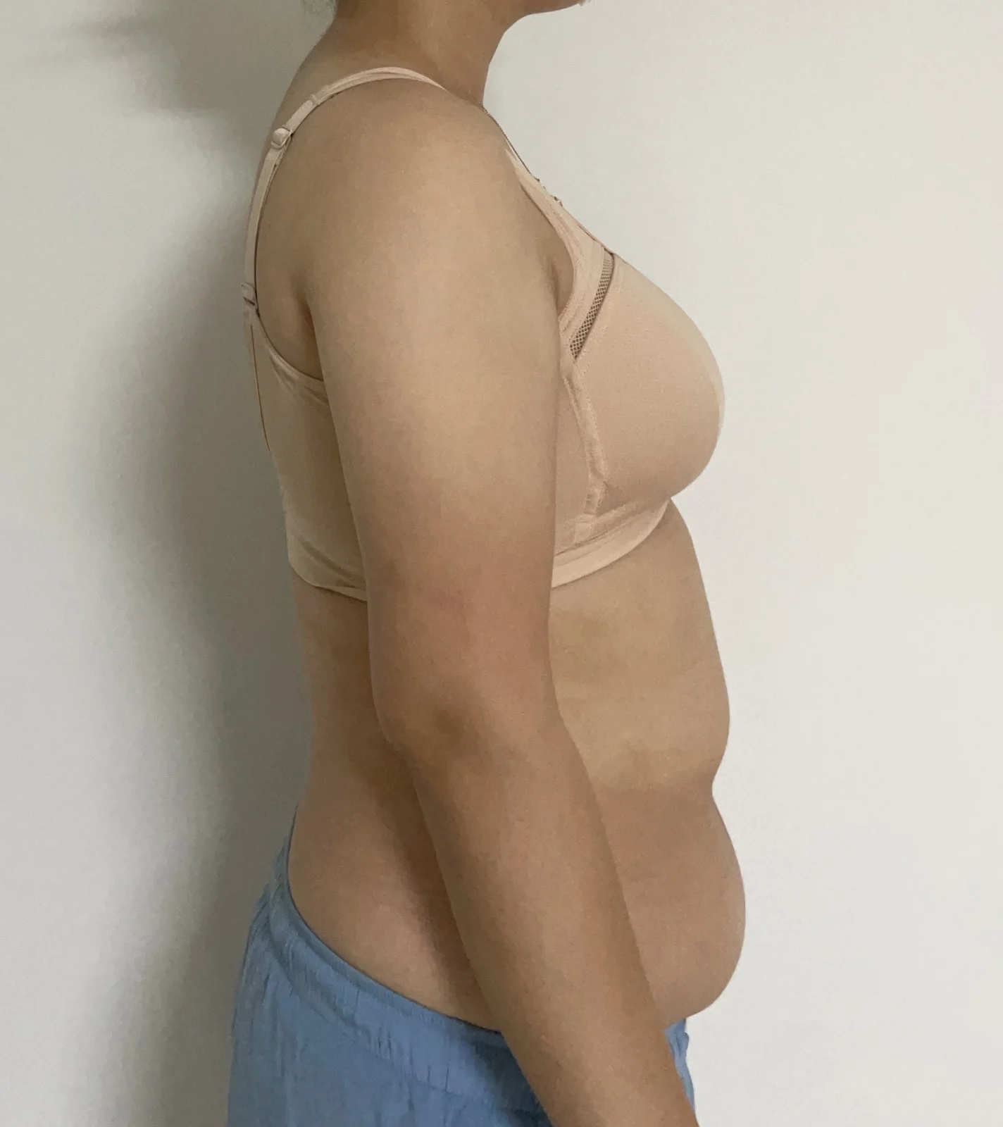 Abdomen and arm lipo review~~ - Arm Liposuction Before 2 - TheLINE Plastic Surgery