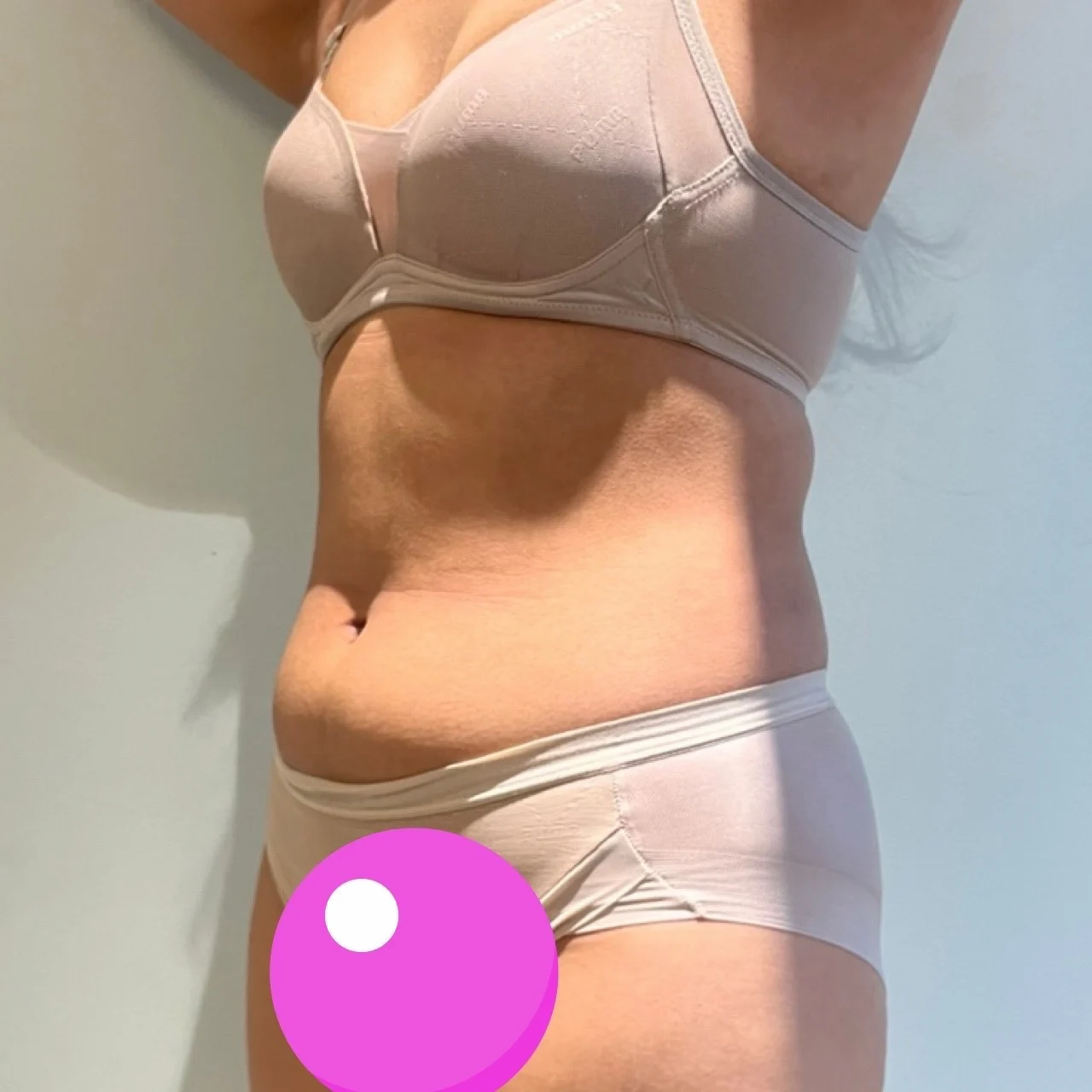3 months after abdominal surgery! - Abdominal Liposuction (Upper Body) Before 2 - TheLINE Plastic Surgery