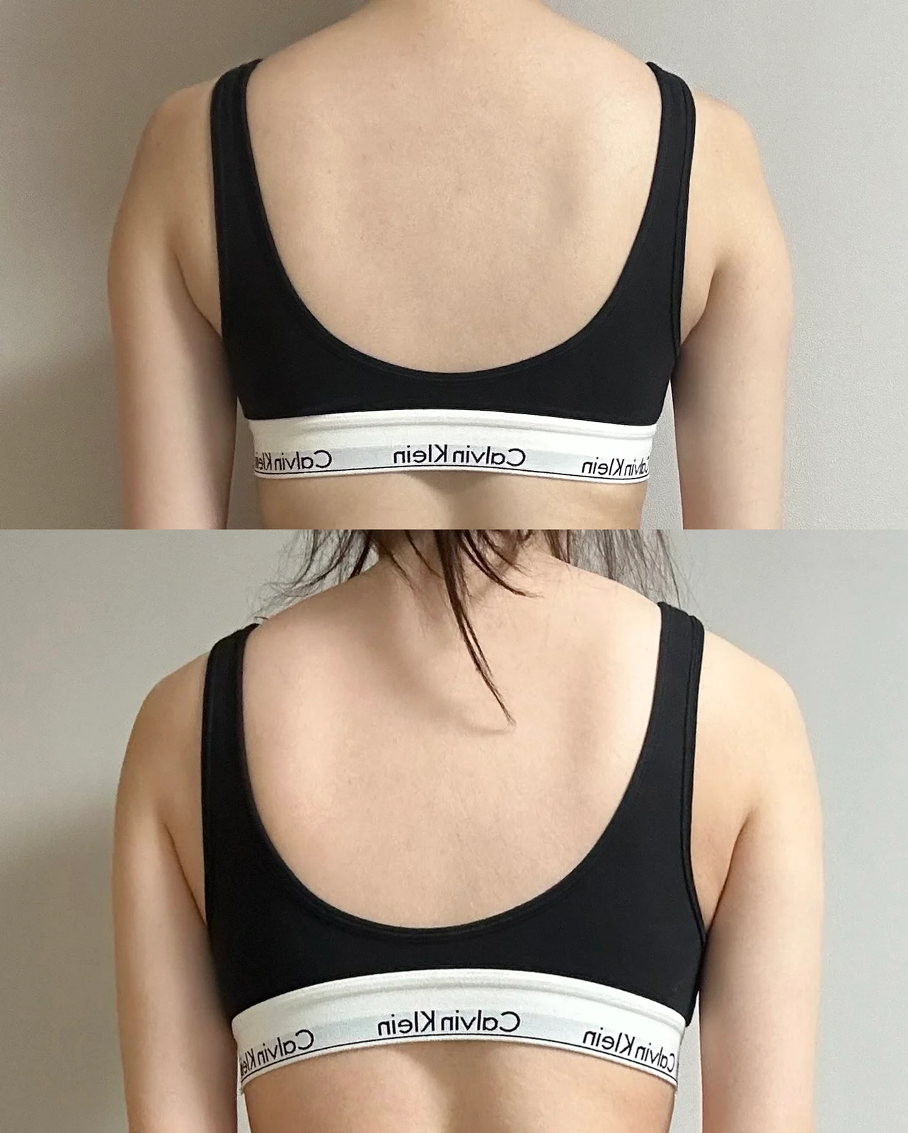 Arm, accessory breast and lower belly li - Arm Liposuction Before 2 - TheLINE Plastic Surgery
