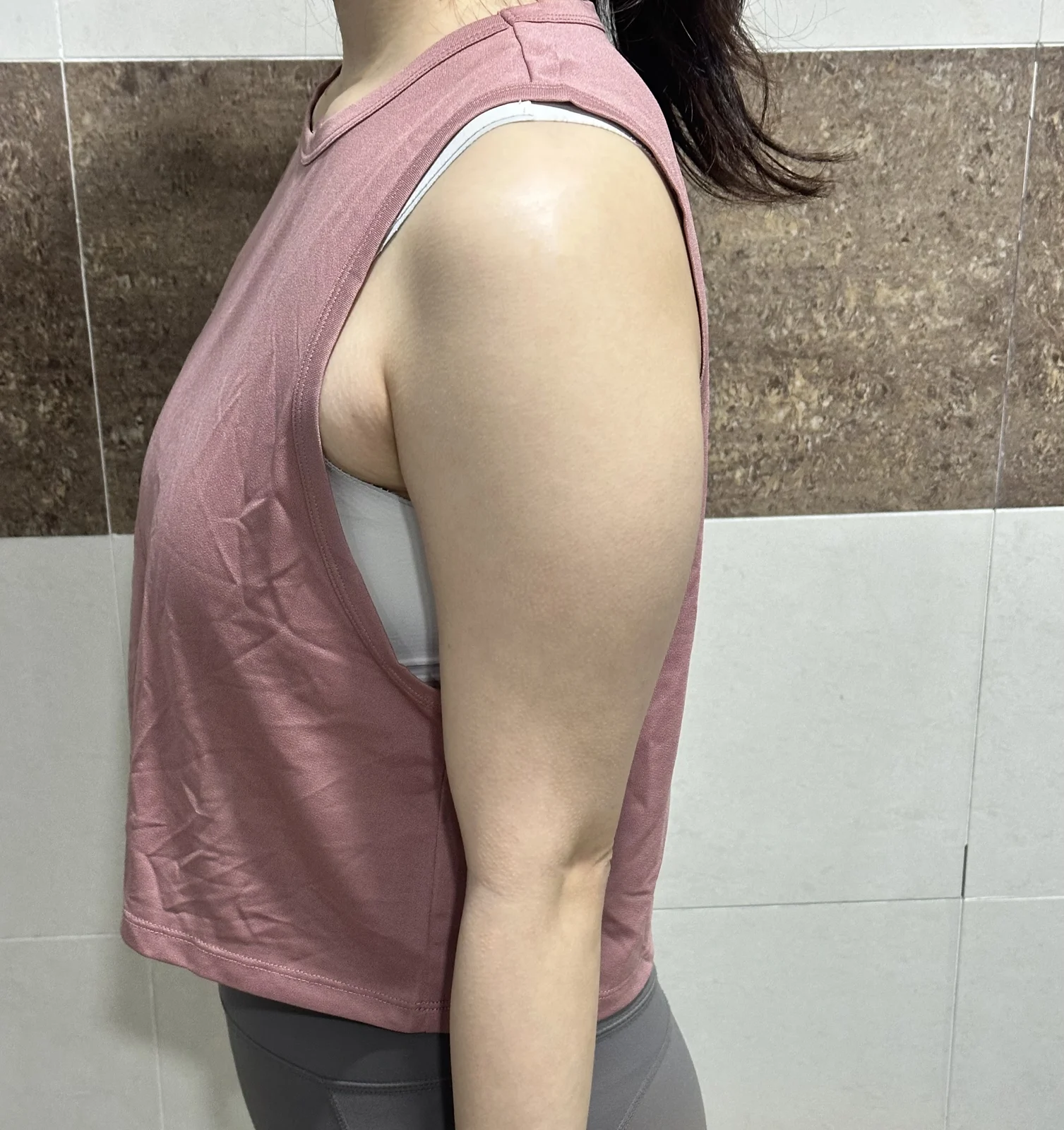 This is my 1-month arm review!! - Arm Liposuction Before 2 - TheLINE Plastic Surgery