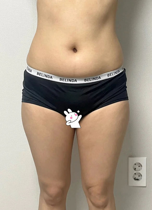 Waist to saddlebags, completely satisfie - Hip Fat Grafting Before 2 - TheLINE Plastic Surgery