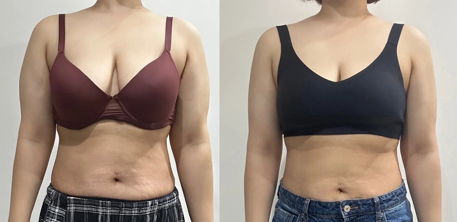 One-month arm review - Arm Liposuction surgery Before photo - TheLINE Plastic Surgery
