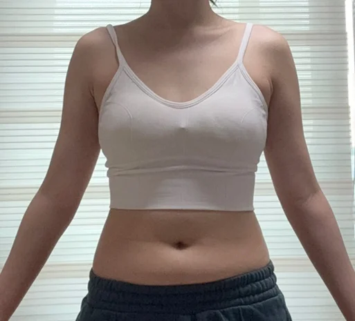 Arm and abdomen review~!! - Arm Liposuction Before 2 - TheLINE Plastic Surgery