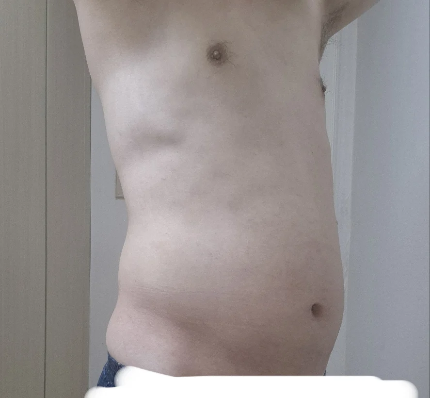 Abdomen review - Abdominal Liposuction (Upper Body) Before 2 - TheLINE Plastic Surgery