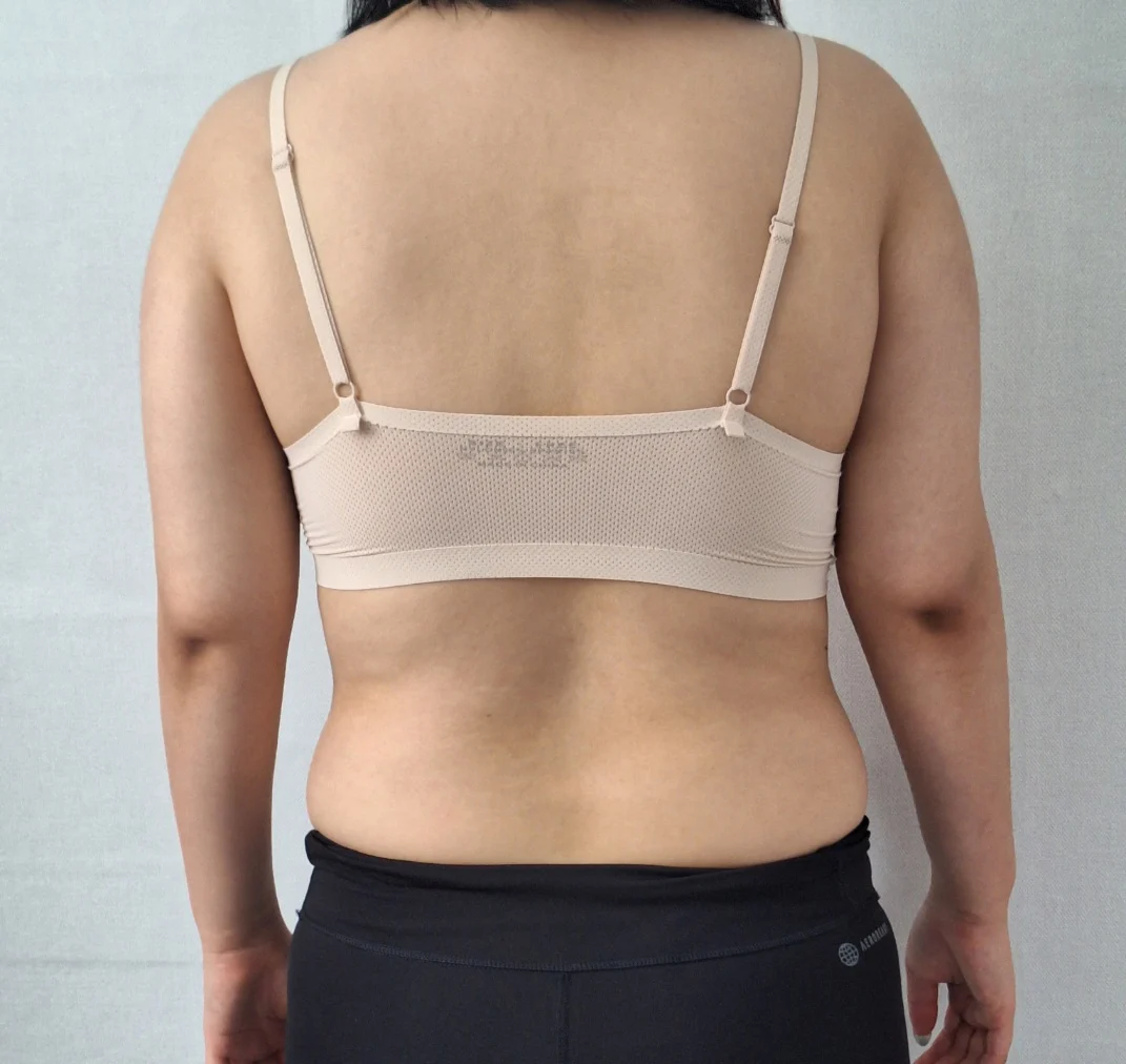 This is my arm and abdomen lipo review! - Arm Liposuction Before 2 - TheLINE Plastic Surgery