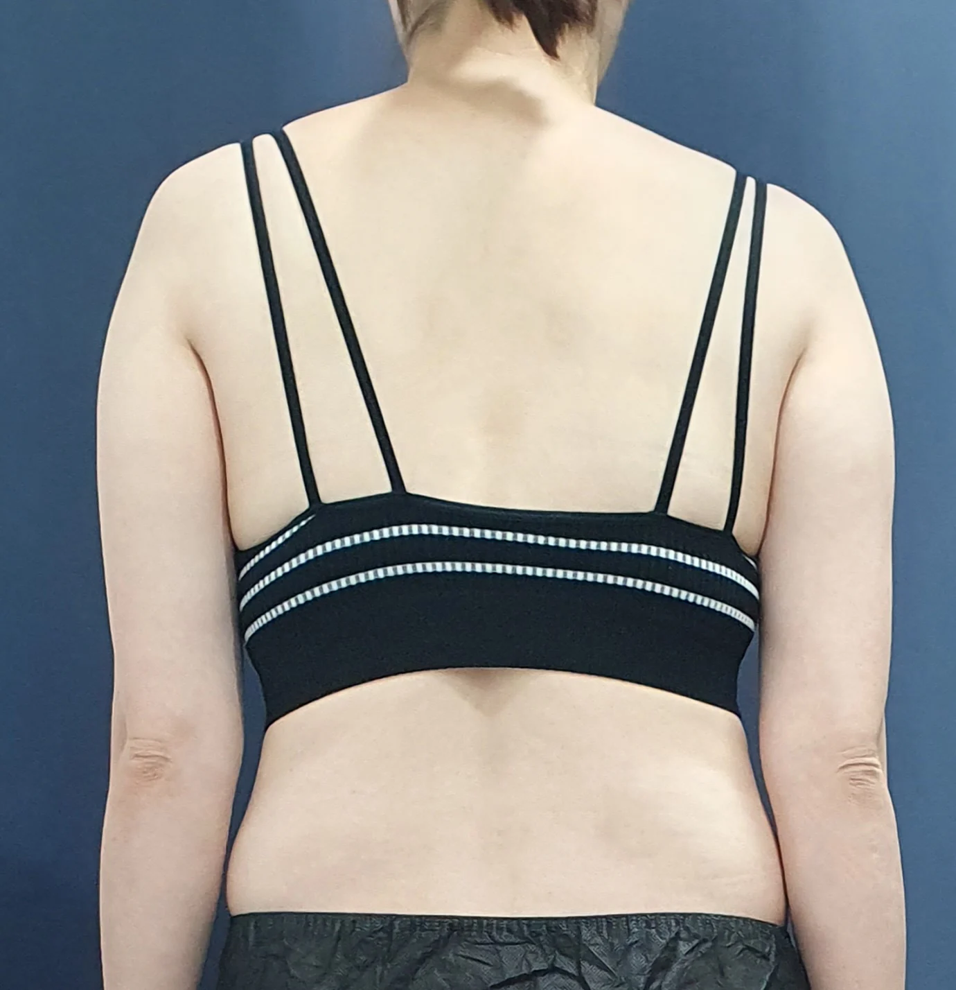 Arm and accessory breast liposuction - Arm Liposuction Before 2 - TheLINE Plastic Surgery