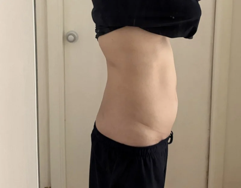 One-month review of my TheLINE surgery - Other Liposuction Before 2 - TheLINE Plastic Surgery
