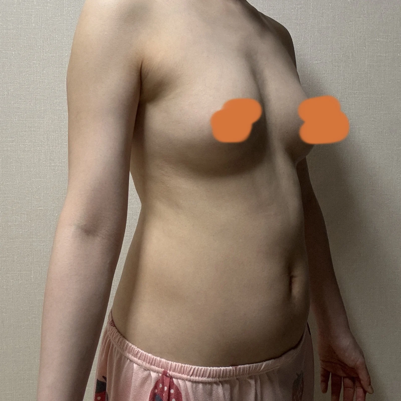 The long-awaited one-month review - Body Contouring Before 2 - TheLINE Plastic Surgery