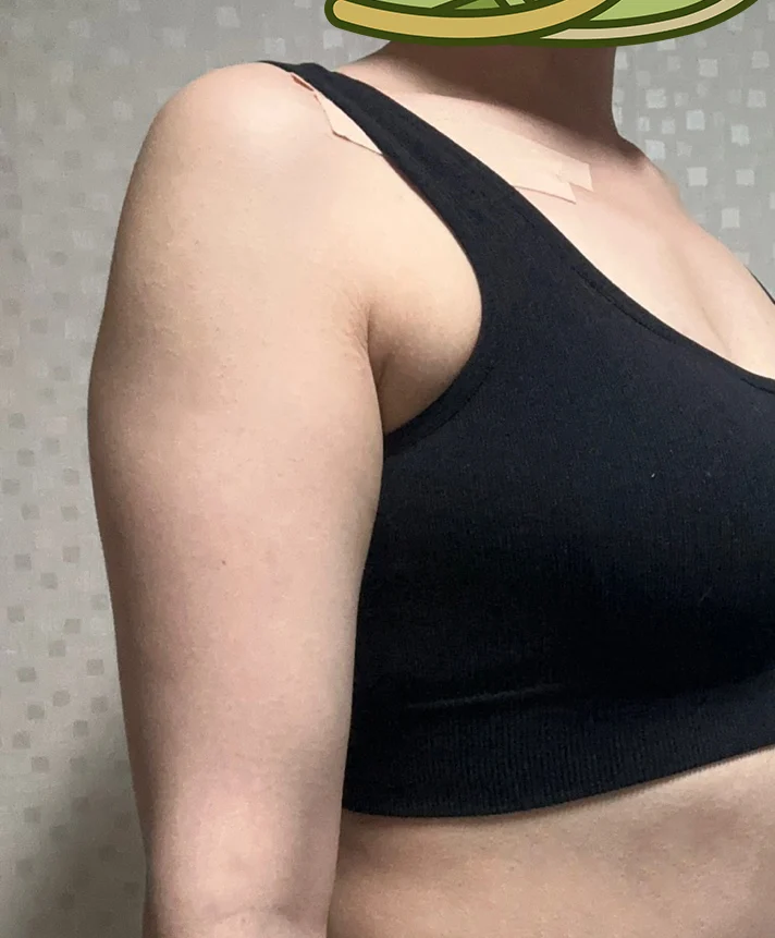 One month after arm and accessory breast - Arm Liposuction Before 2 - TheLINE Plastic Surgery