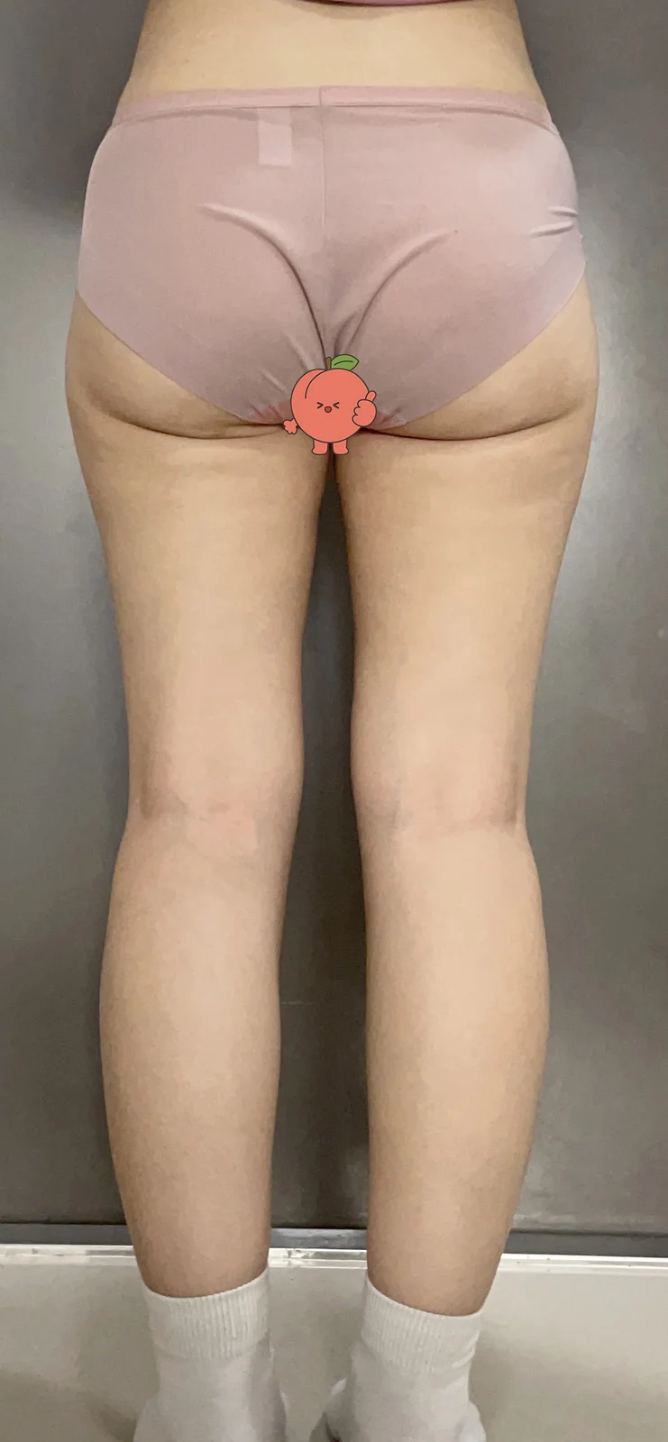 Thigh and hip liposuction review - Hip Fat Grafting Before 2 - TheLINE Plastic Surgery