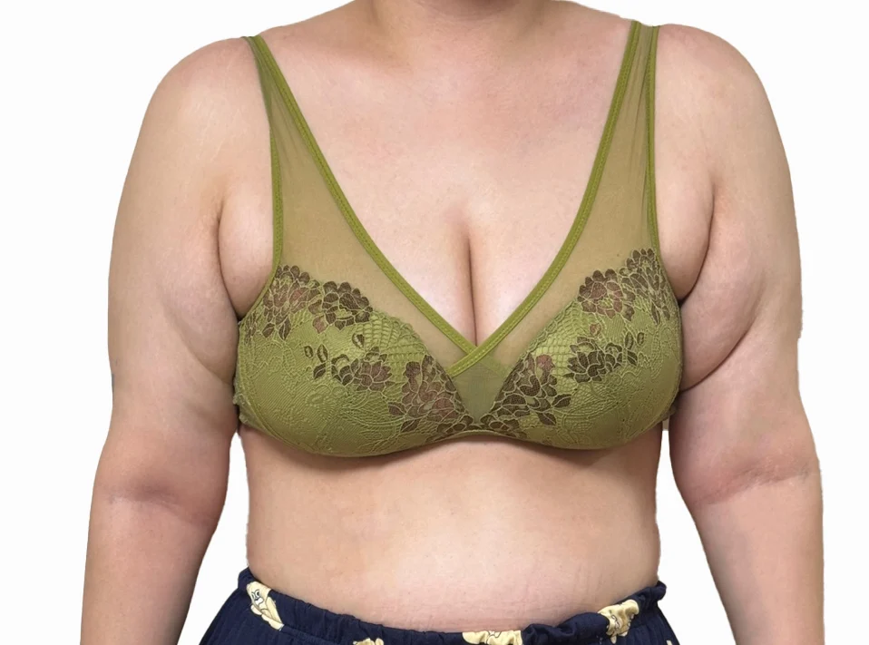 It's been 6 months since my arm lift - Body Contouring surgery Before photo - TheLINE Plastic Surgery
